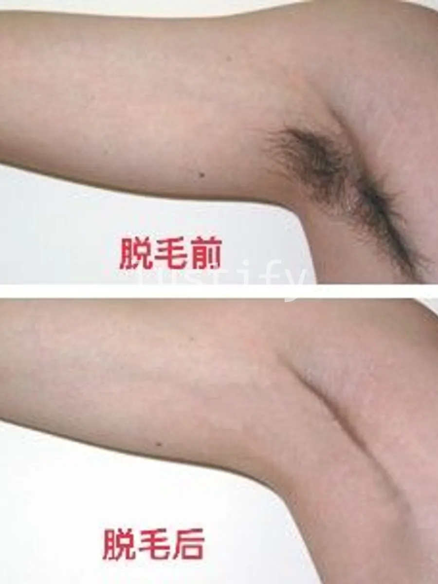 Photo 3 of Laser Hair Removal